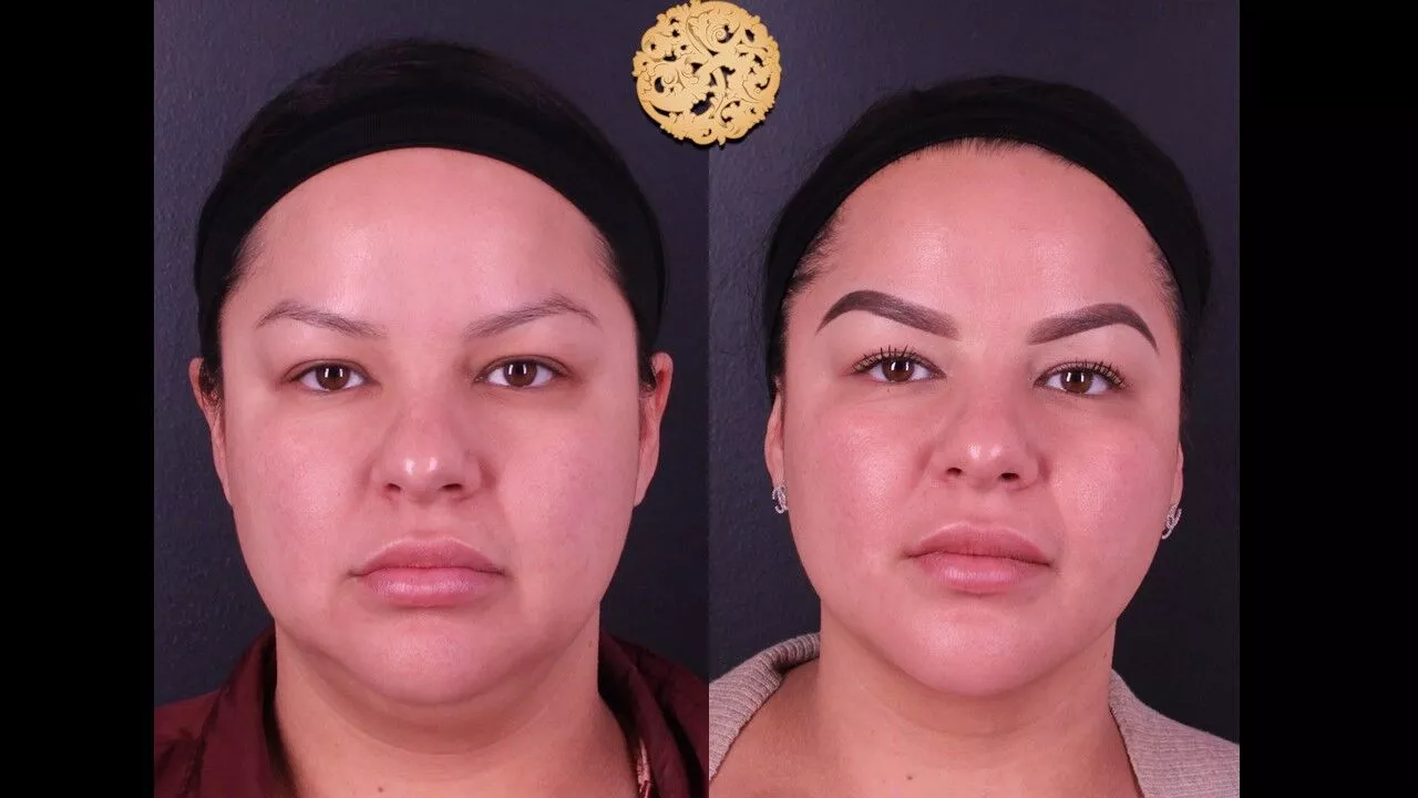 Double Chin Treatment Before & After