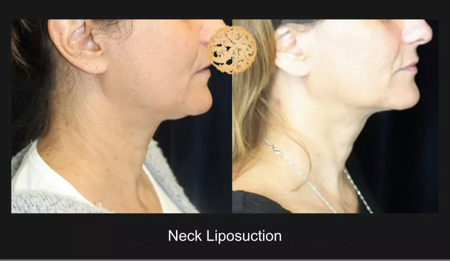 Double Chin Treatment Before & After