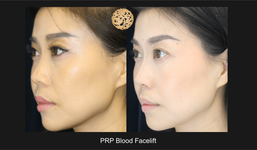 PRP Blood Facial Before & After
