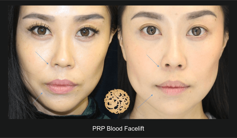 PRP Blood Facial Before & After