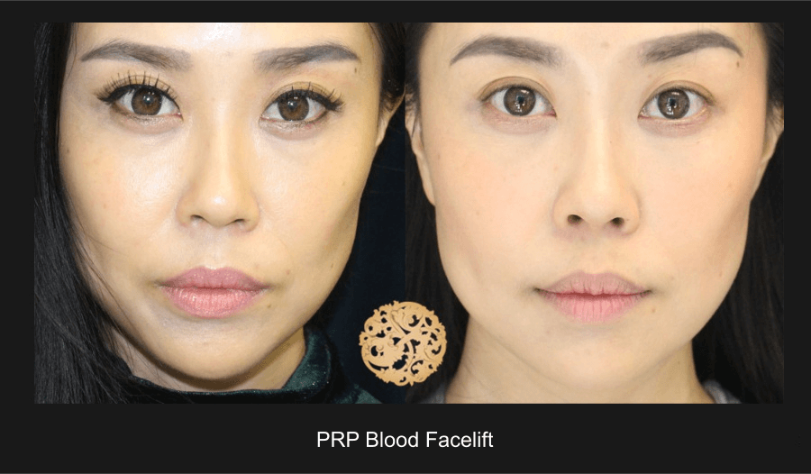 Prp Blood Facial Before & After