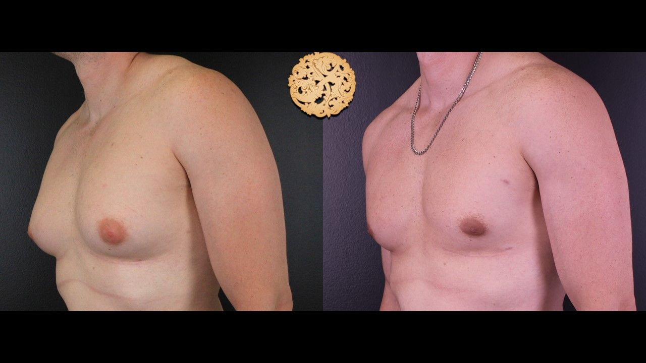 Bodytite Before & After