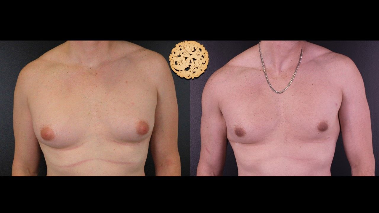 Bodytite Before & After