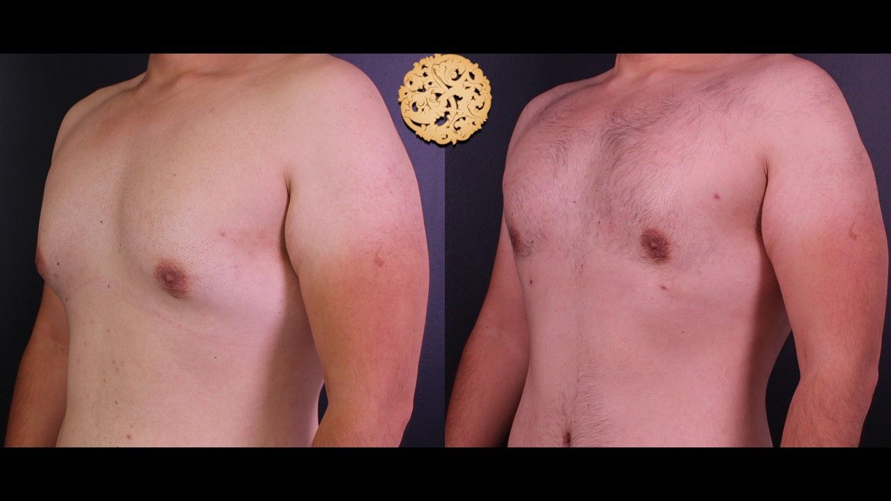 Bodytite Before & After