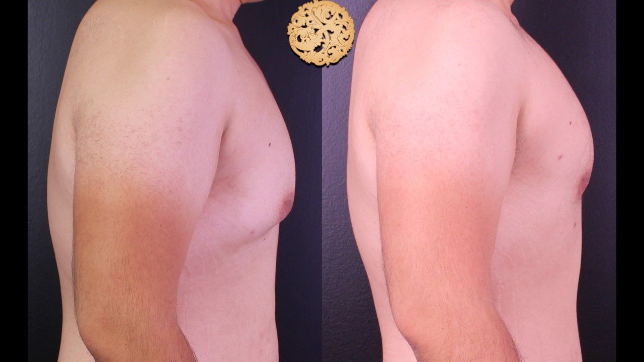 Bodytite Before & After