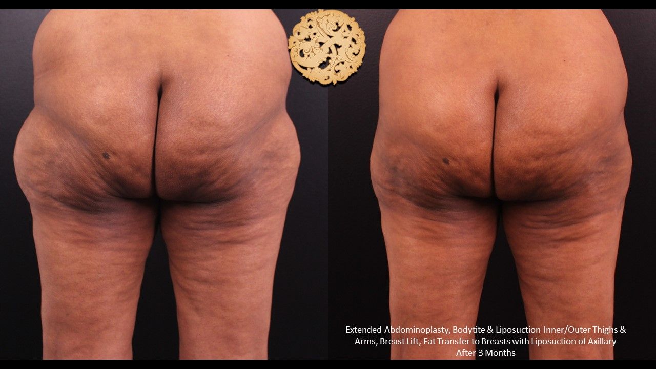 Bodytite Before & After