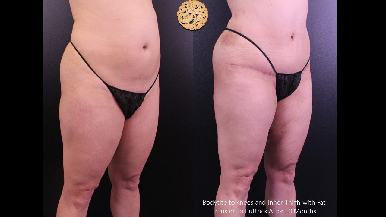 Bodytite Before & After