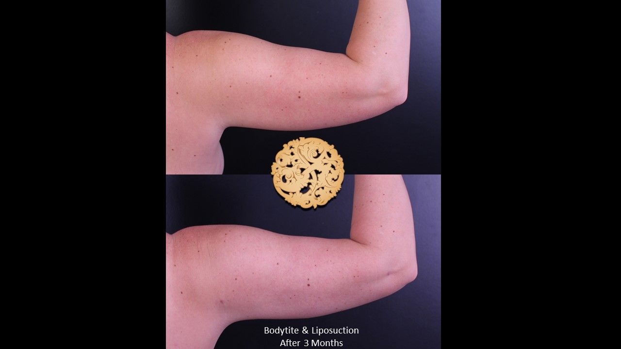 Bodytite Before & After