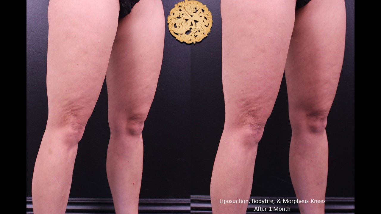 Bodytite Before & After