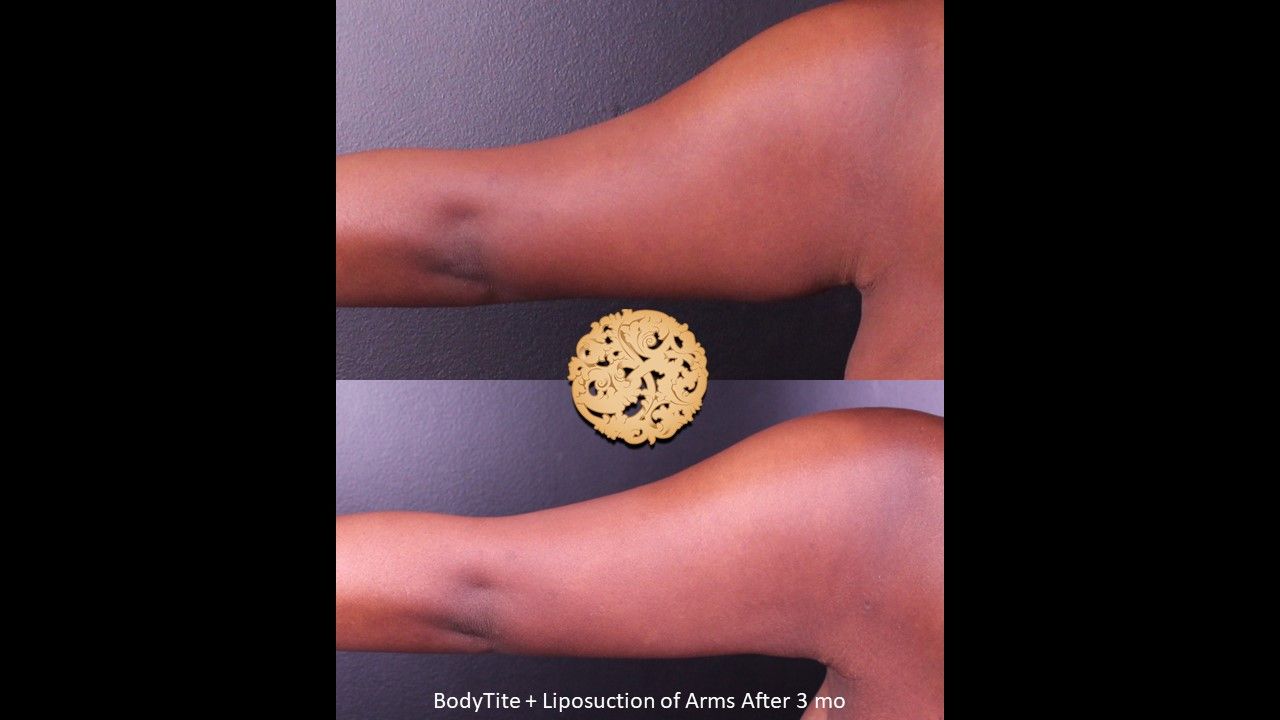 Bodytite Before & After