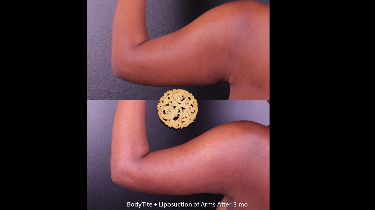 Bodytite Before & After