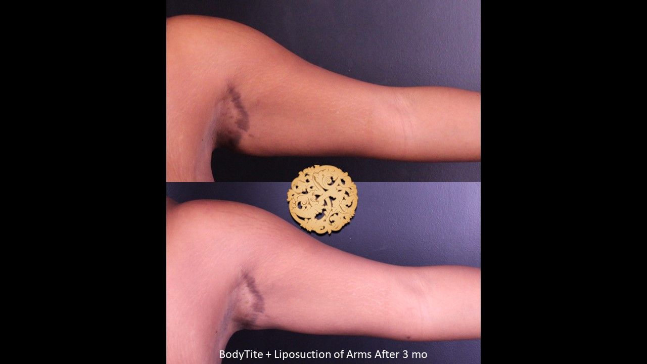 Bodytite Before & After