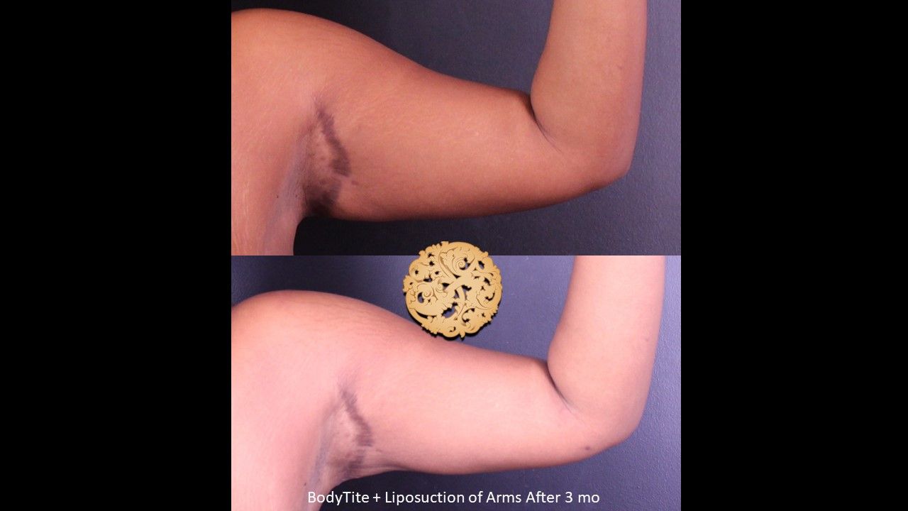 Bodytite Before & After