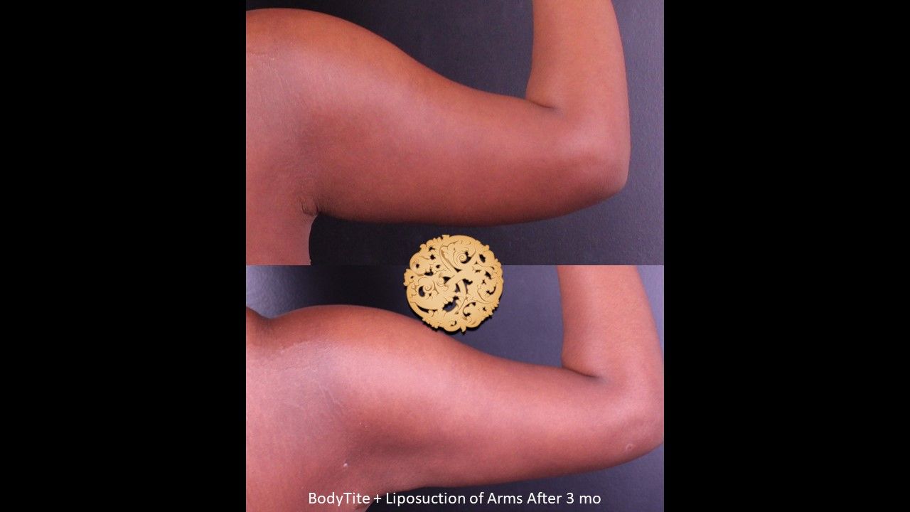 Bodytite Before & After