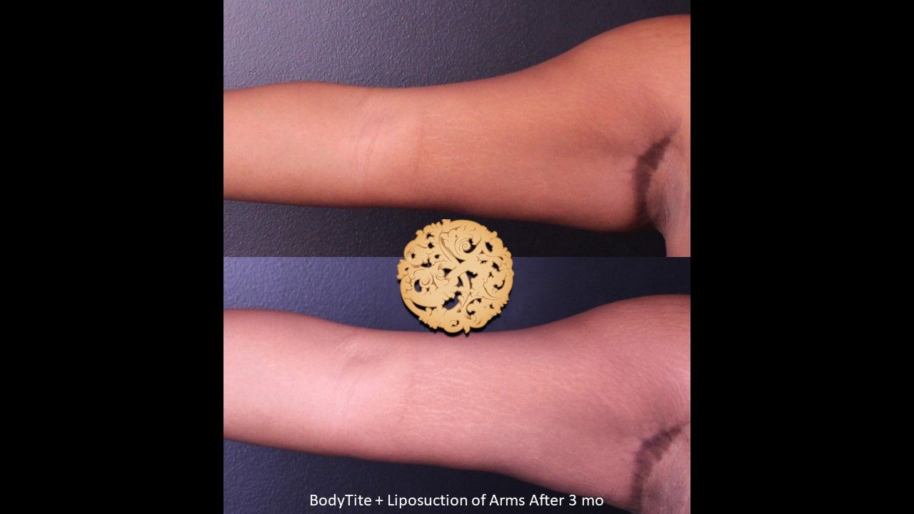 Bodytite Before & After