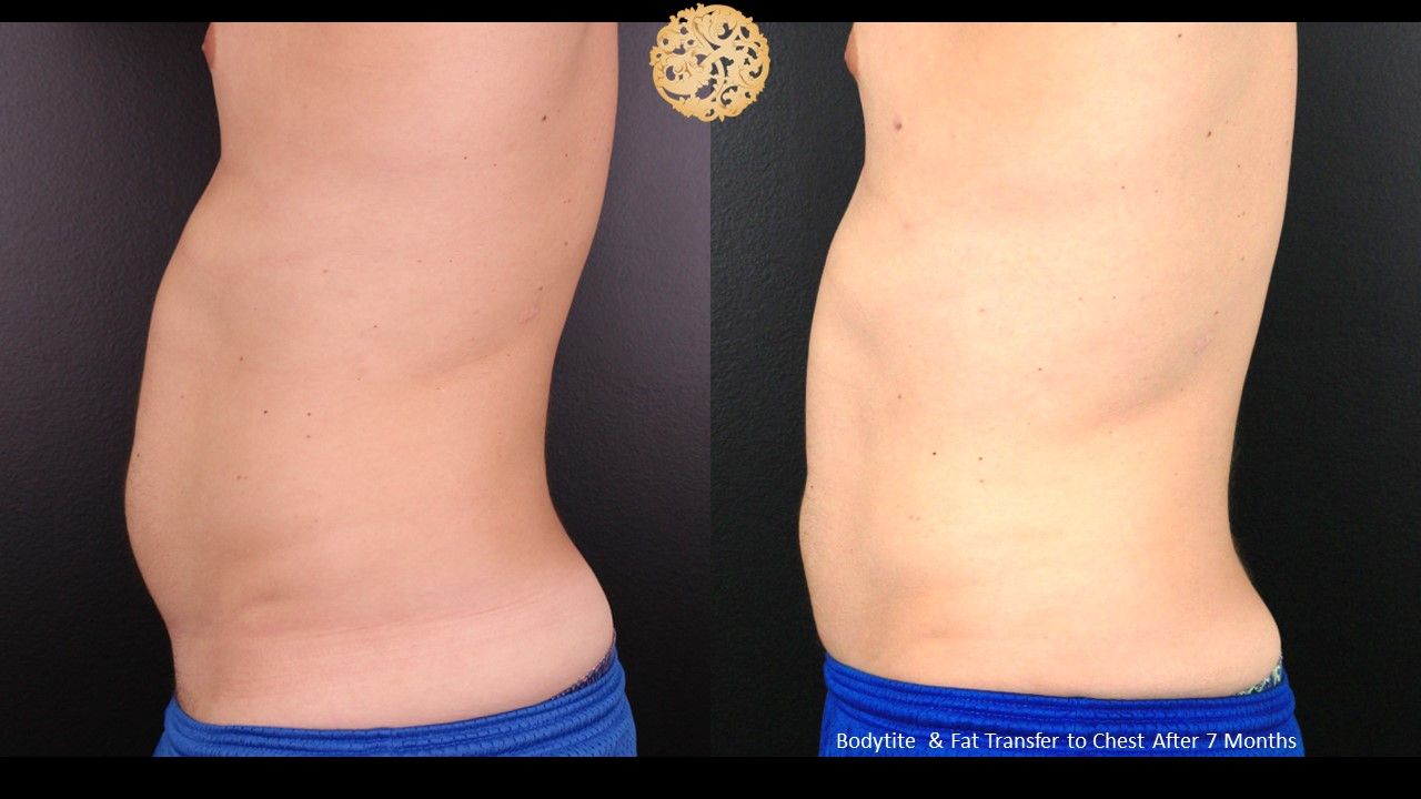 Bodytite Before & After