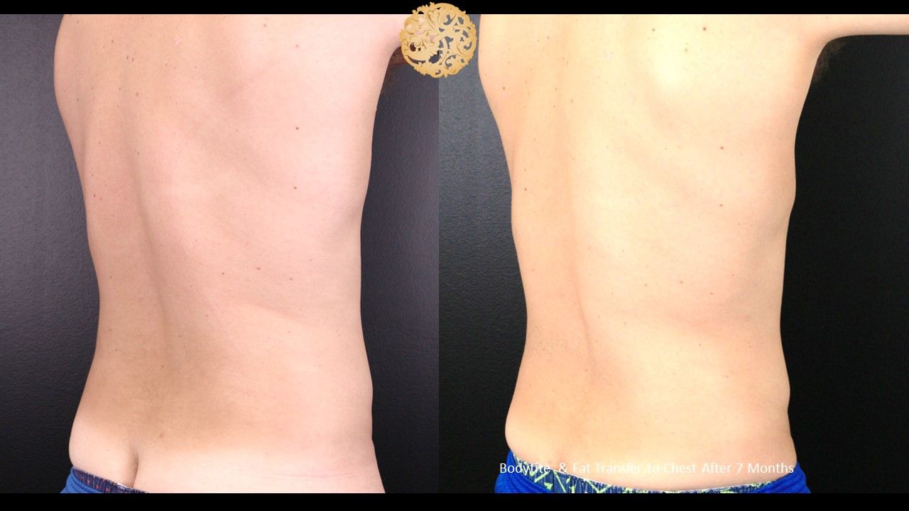 Bodytite Before & After