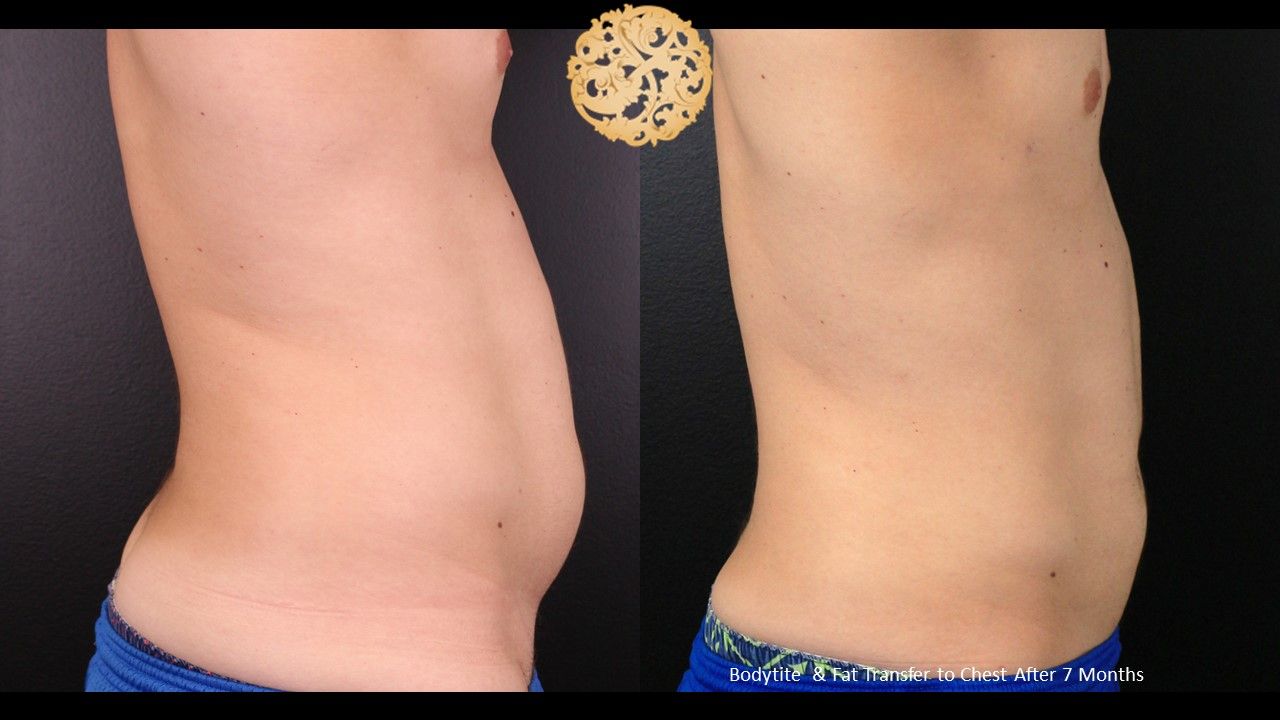 Bodytite Before & After