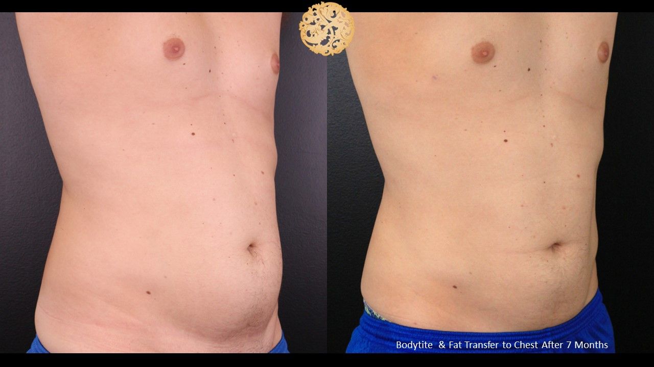 Bodytite Before & After