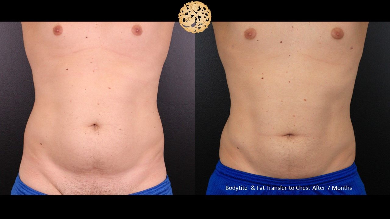 Bodytite Before & After