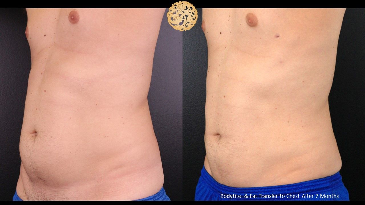 Bodytite Before & After