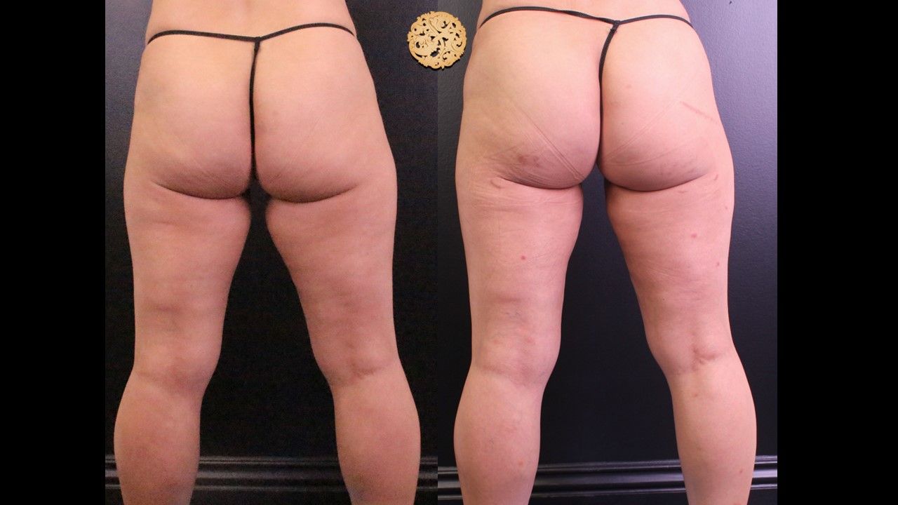 Bodytite Before & After