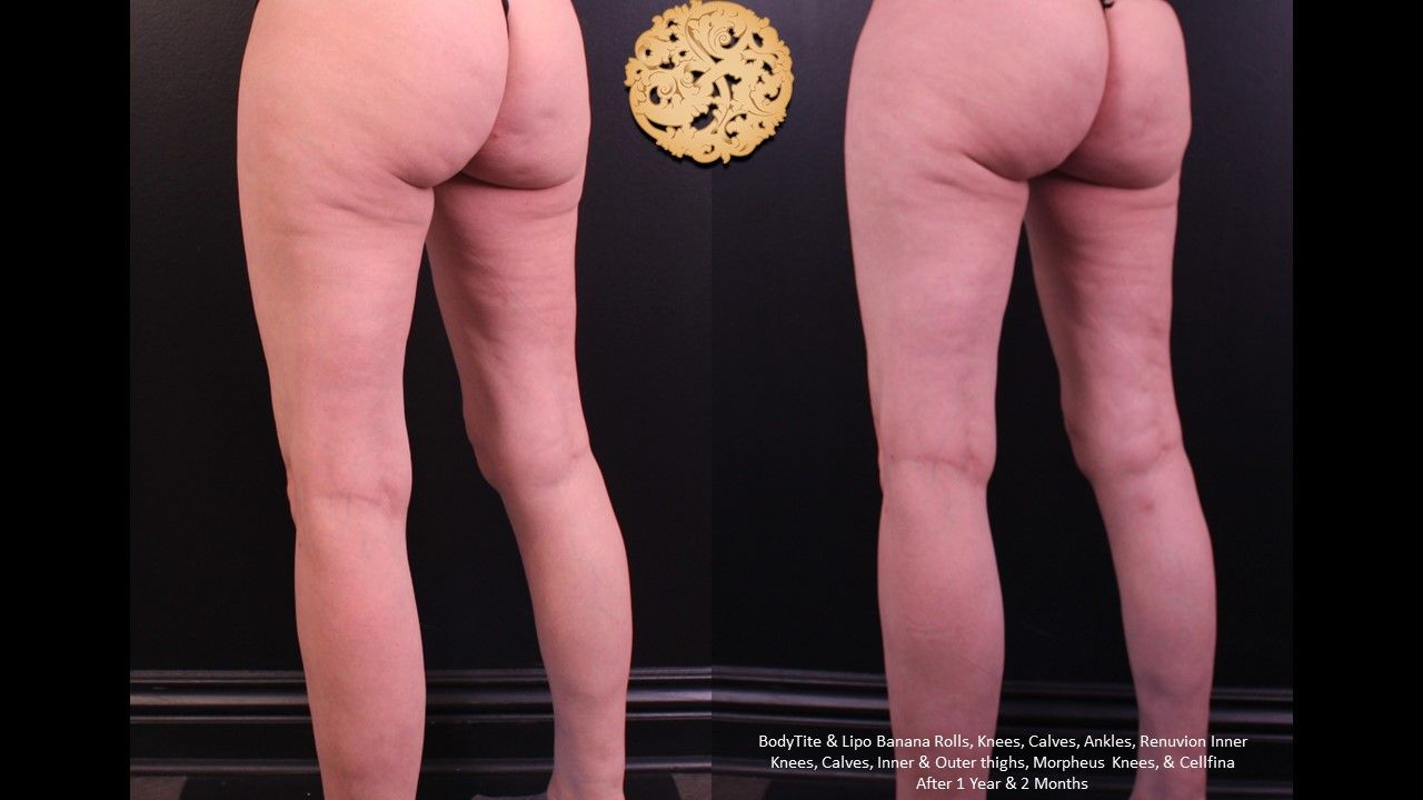 Bodytite Before & After