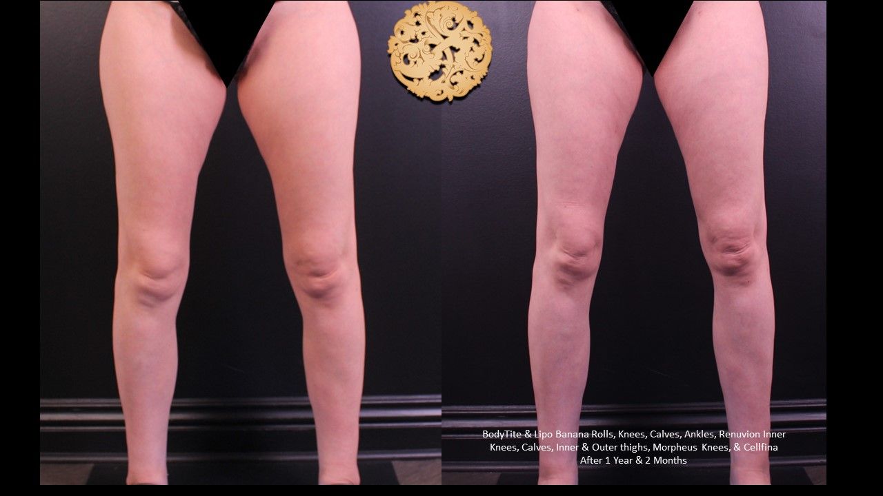 Bodytite Before & After