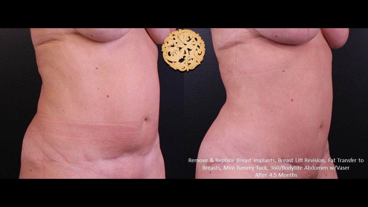 Bodytite Before & After