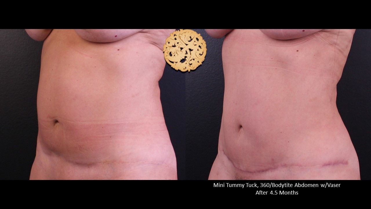 Bodytite Before & After