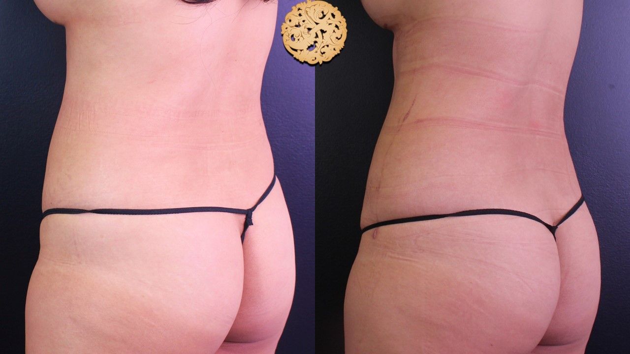 Bodytite Before & After