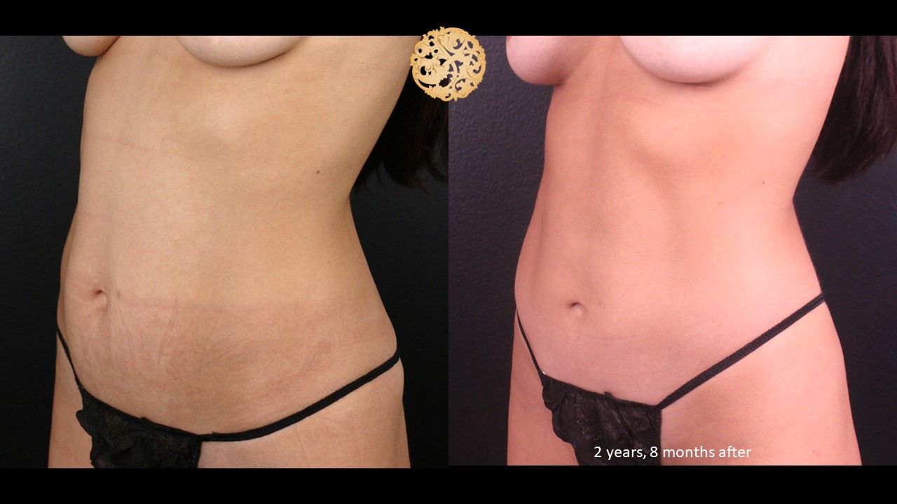 Bodytite Before & After