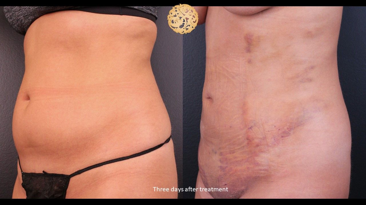 Bodytite Before & After