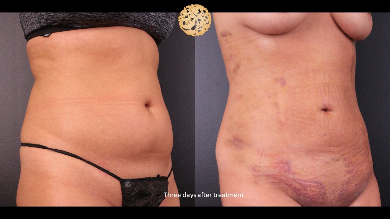 Bodytite Before & After