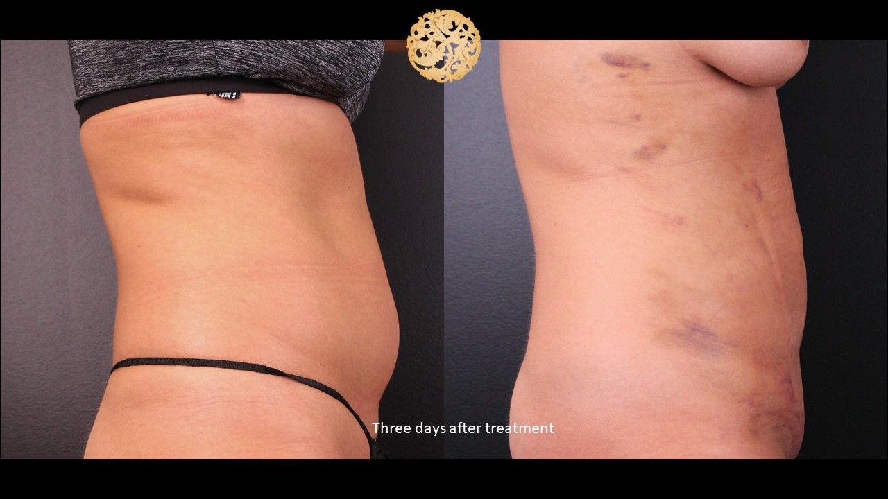 Bodytite Before & After