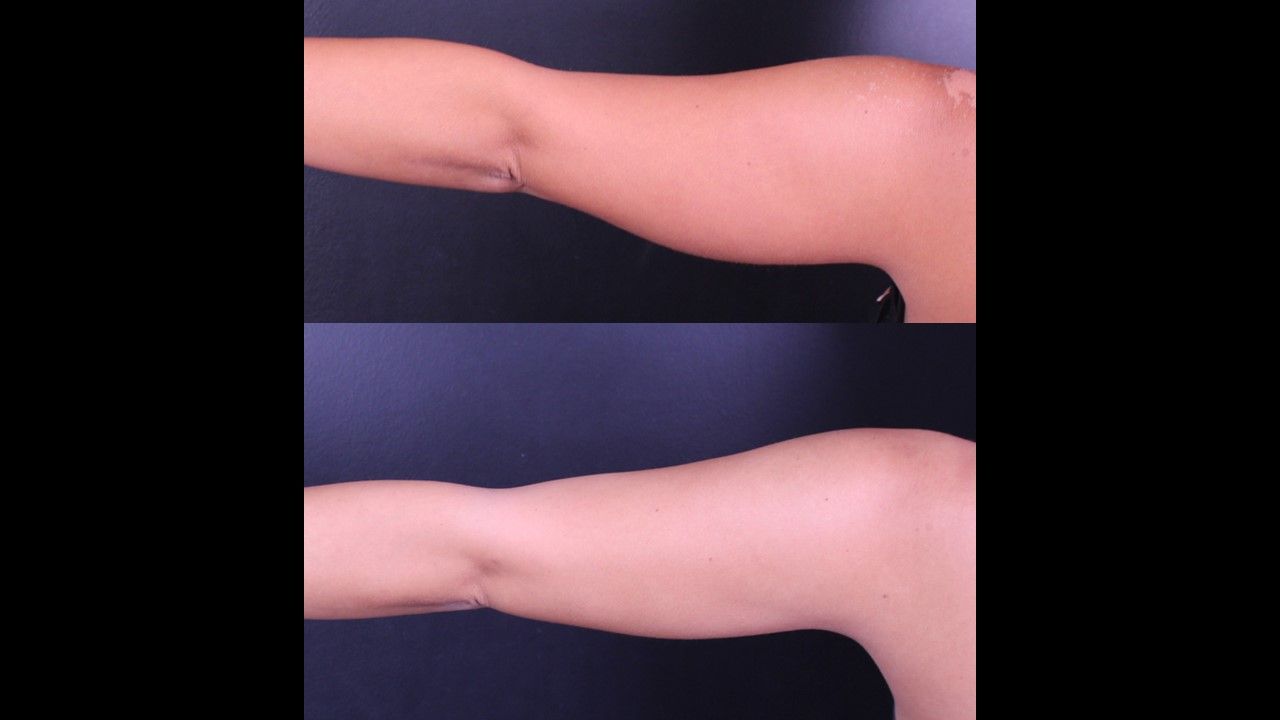 Bodytite Before & After