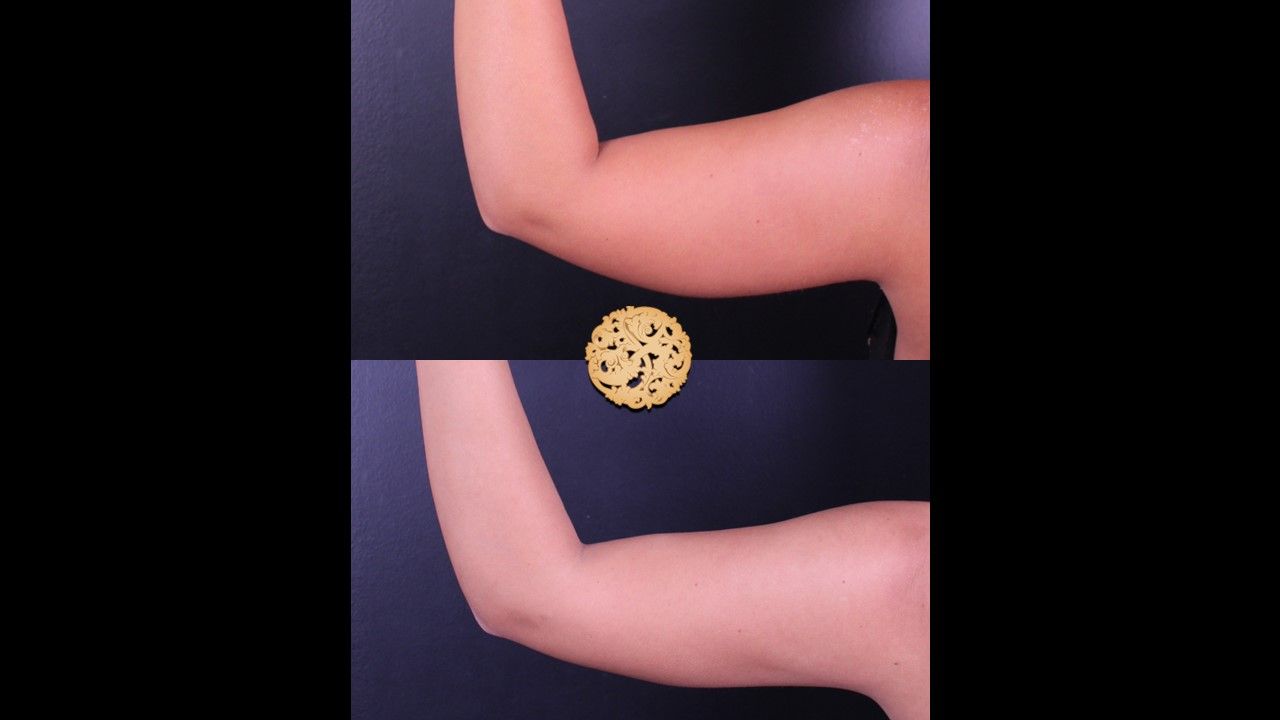 Bodytite Before & After