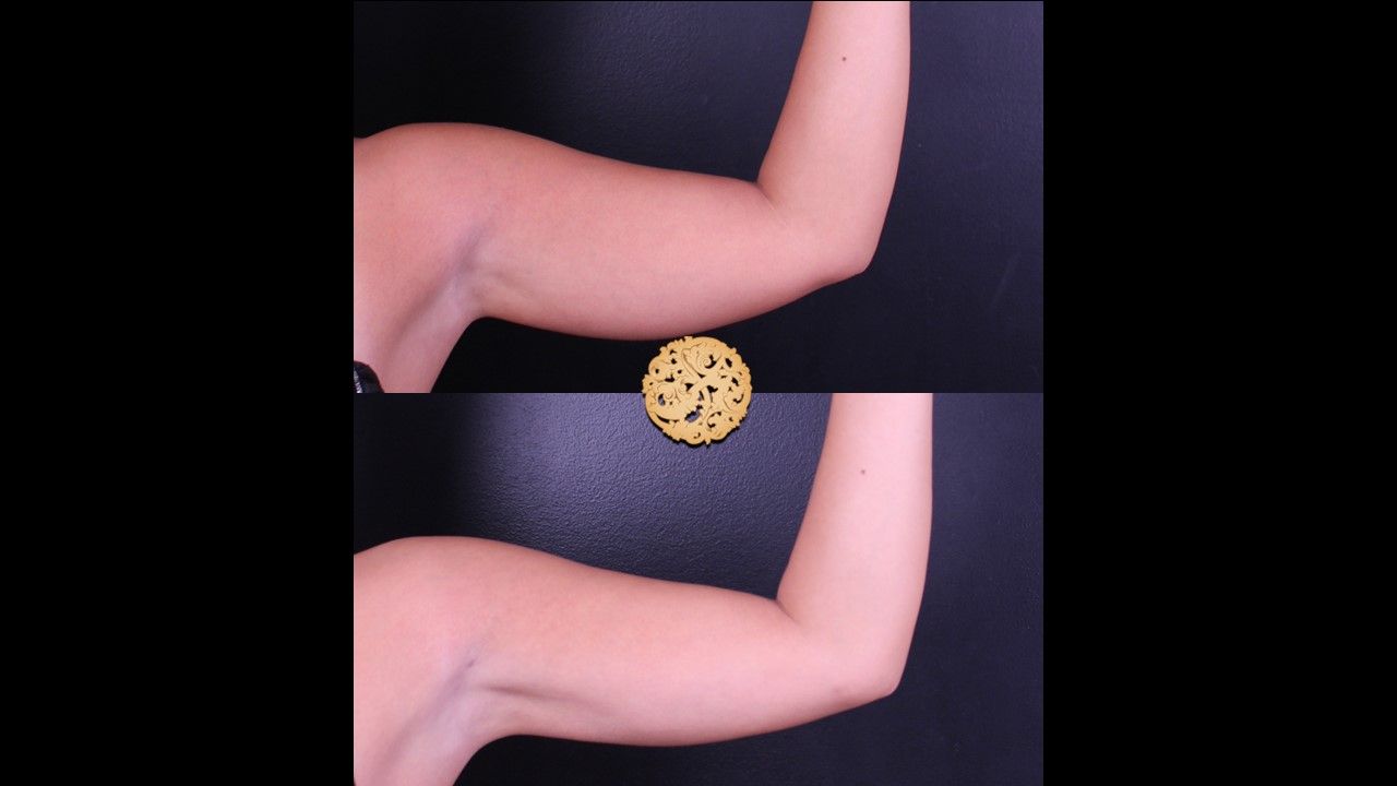 Bodytite Before & After