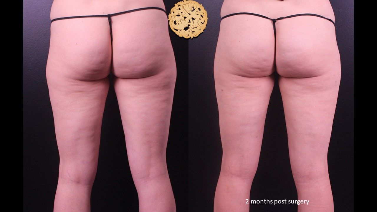 Bodytite Before & After