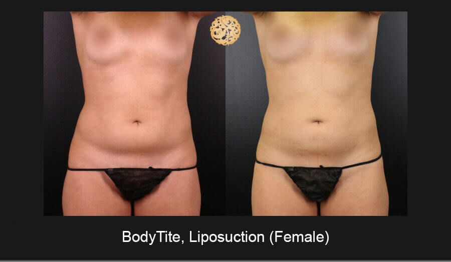 Bodytite Before & After