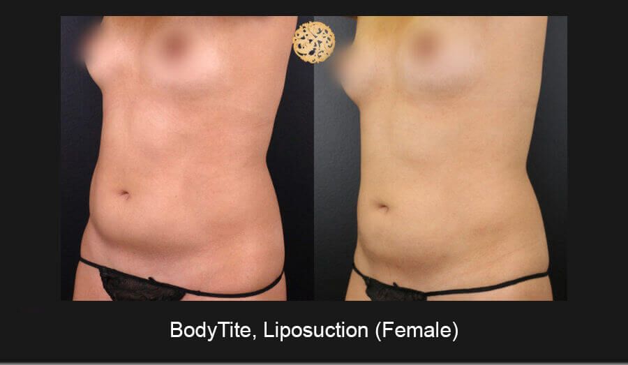 Bodytite Before & After