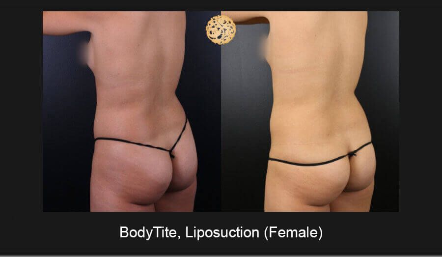 Bodytite Before & After