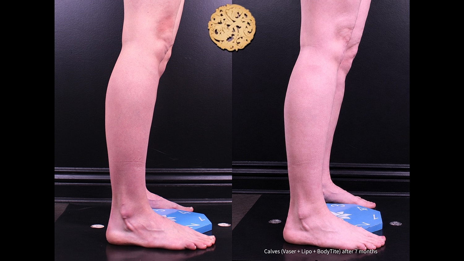 Before and after calf transformation photos.