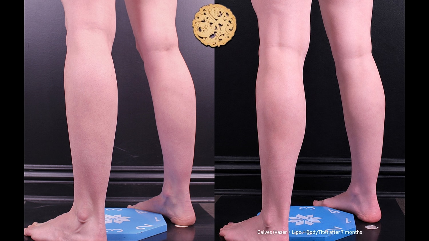 Calves ( Vaser + Lipo + BodyTite) after 7 months