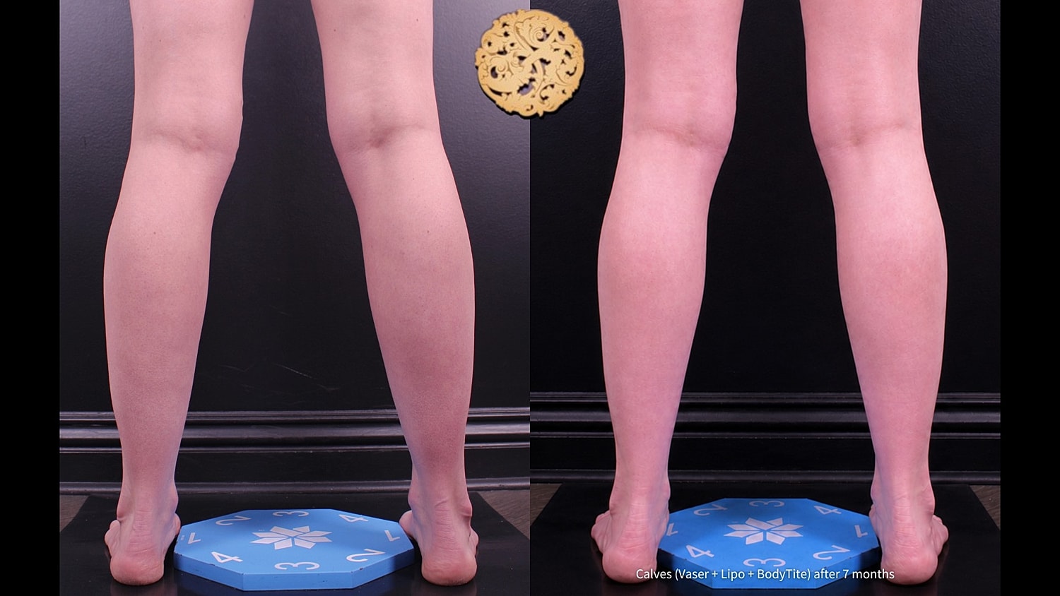 Calves ( Vaser + Lipo + BodyTite) after 7 months