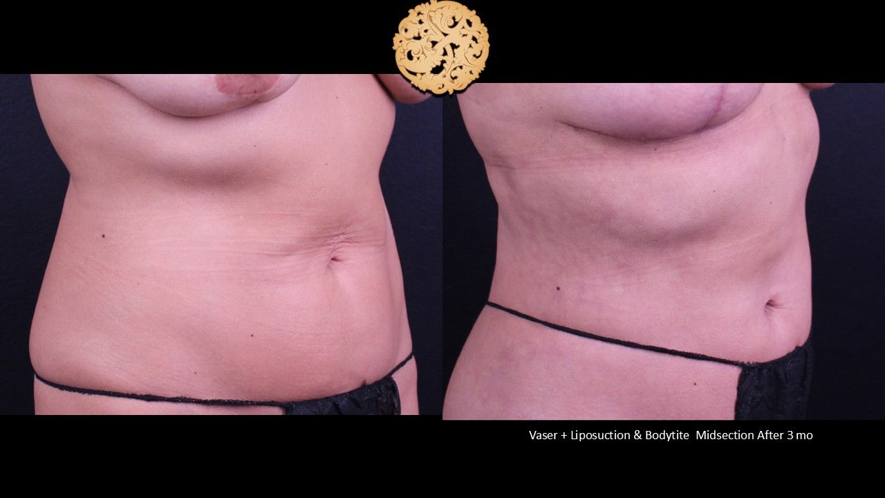 BodyTite Before & After