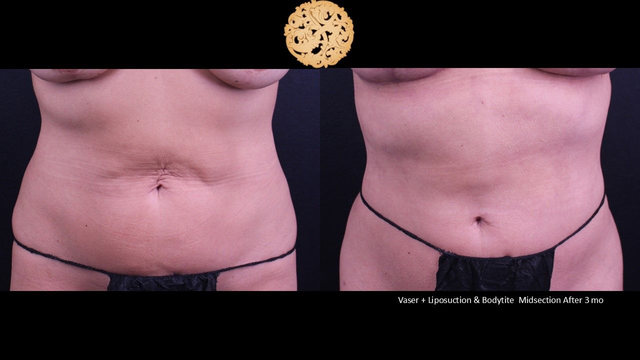 BodyTite Before & After