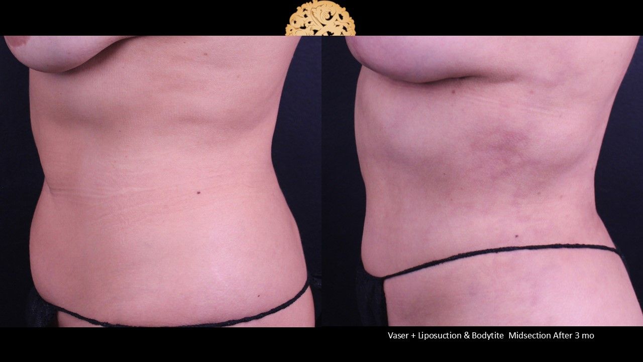 BodyTite Before & After