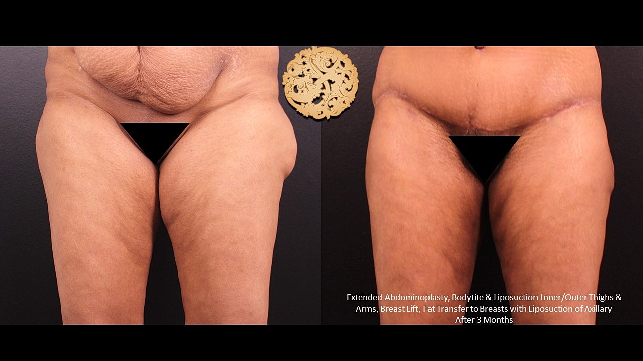 Before and after body contouring results.