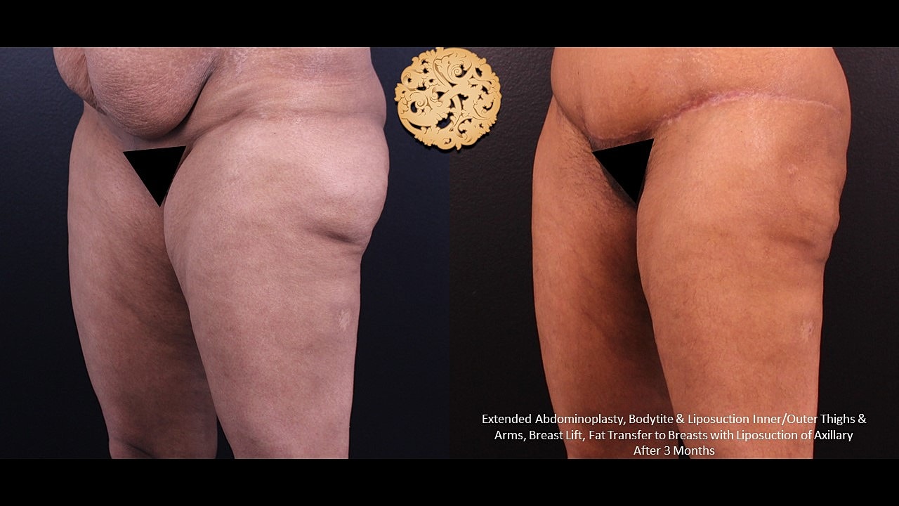 Surgical body transformation before and after images.